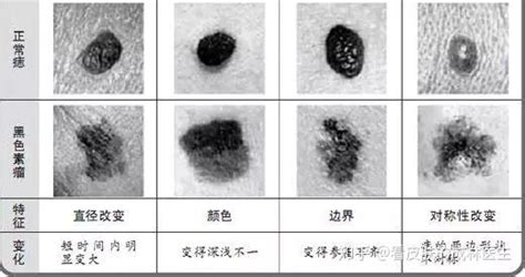 黑痣凸起|身上长了黑痣就是黑色素瘤吗？该怎样判断？